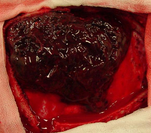 blood clot